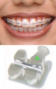 Bracketi Clarity de la Ortho Shop